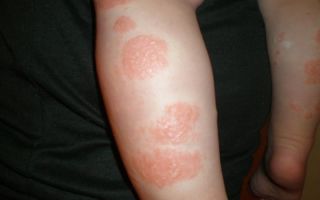 Как лечить аллергический дерматит у детей