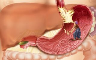 Желудочно-кишечный тракт   воспаление  — народные средства и народная медицина