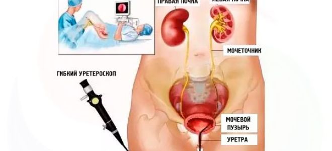 Камни в мочевом пузыре — народные средства и методы / народная медицина