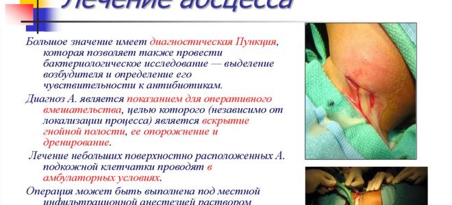 Абсцесс кожи – как лечить абсцесс народными средствами