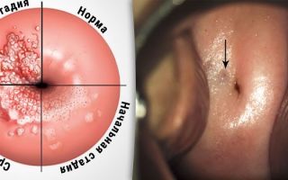 Заболевания женских половых органов — народные средства, народная медицина