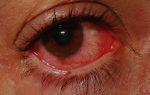 Острый катаральный конъюнктивит: симптомы