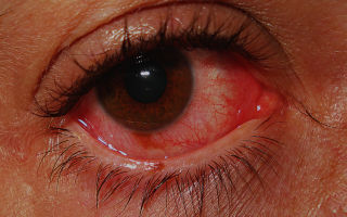 Острый катаральный конъюнктивит: симптомы