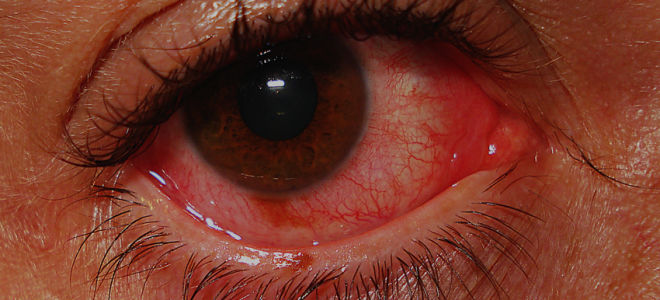 Острый катаральный конъюнктивит: симптомы