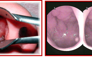 Как лечить аденоиды дома  —  аденоиды и  народная медицина