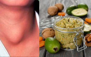 Зоб — народные средства и рецепты, народная медицина