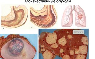 Злокачественные опухоли в ранней стадии – народные средства и рецепты для исцеления