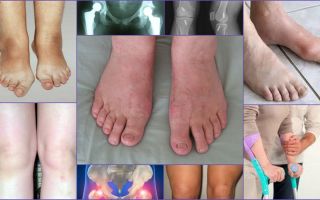 Выведение из организма шлаков и токсичных металлов / народная медицина / народные средства