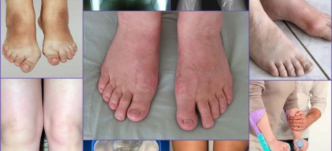 Выведение из организма шлаков и токсичных металлов / народная медицина / народные средства