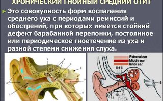Хроническое воспаление среднего уха: лечение и профилактика