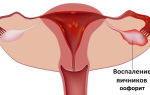 Оофорит: воспаление яичников | причины и симптомы