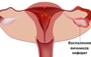 Оофорит: воспаление яичников | причины и симптомы