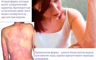 Крапивница: причины возникновения, симптомы и методы лечения