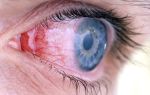 Конъюнктивит: симптомы и способы лечения, причины конъюнктивита