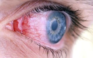 Конъюнктивит: симптомы и способы лечения, причины конъюнктивита